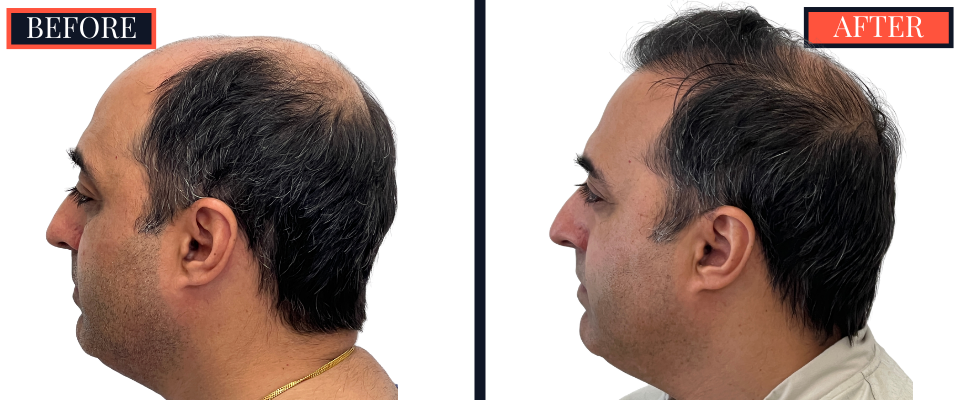 3078 GRAFT STRIP Hair Transplant - THTS RESULTS