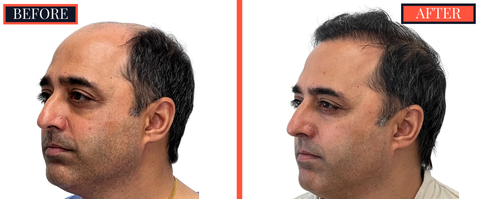 3078 GRAFT STRIP Hair Transplant - THTS RESULTS