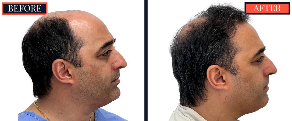 3078 GRAFT STRIP Hair Transplant - THTS RESULTS