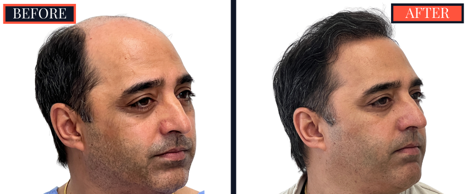 3078 GRAFT STRIP Hair Transplant - THTS RESULTS