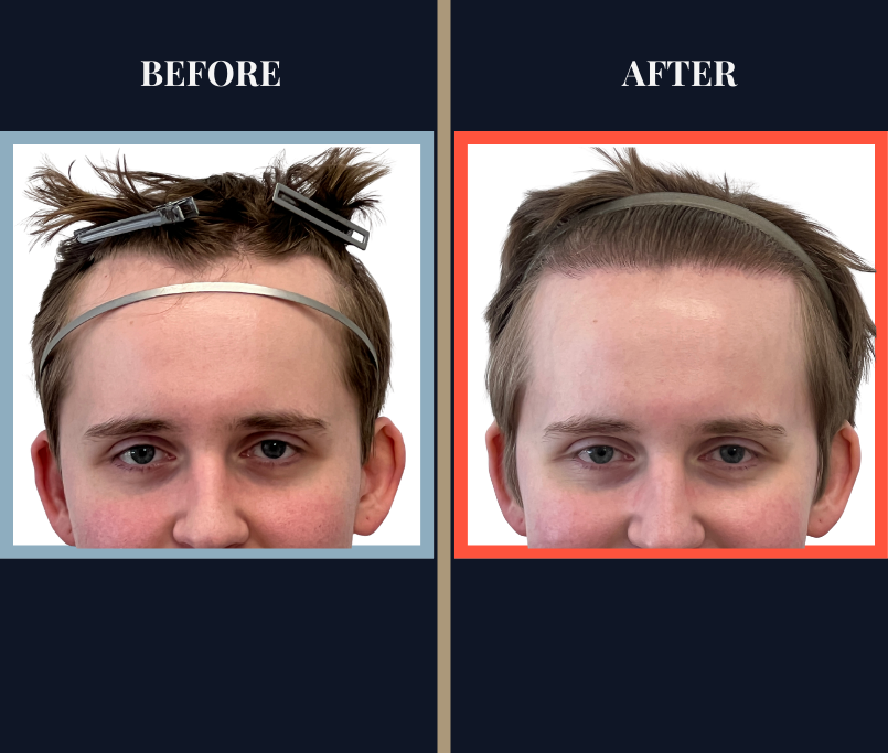 THTS Partial Shave - 753 GRAFT FUE - Results