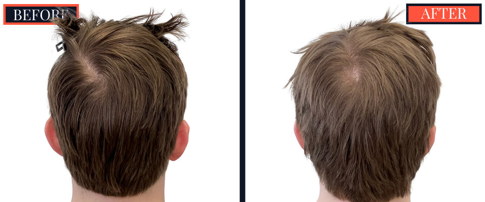 THTS Partial Shave - 753 GRAFT FUE - Results