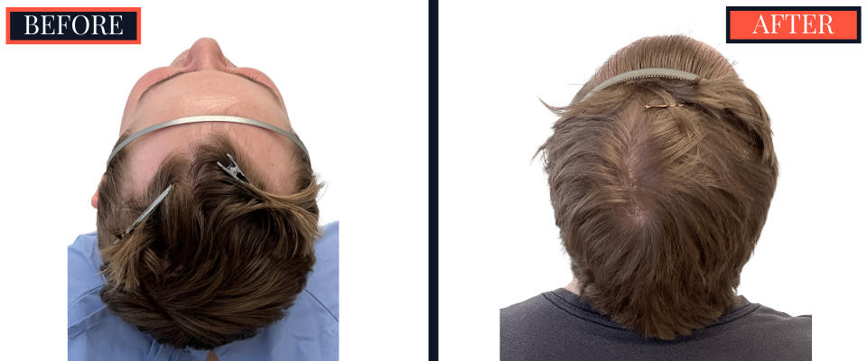 THTS Partial Shave - 753 GRAFT FUE - Results