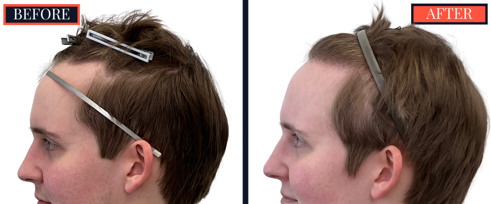 THTS Partial Shave - 753 GRAFT FUE - Results