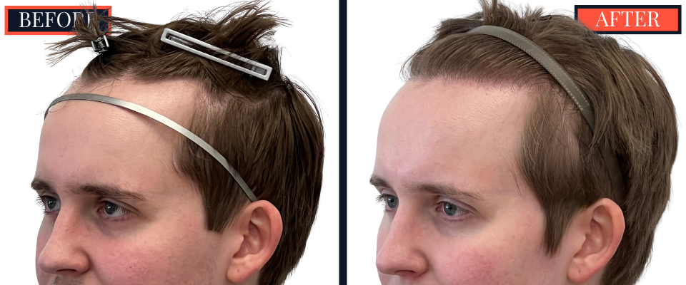 THTS Partial Shave - 753 GRAFT FUE - Results