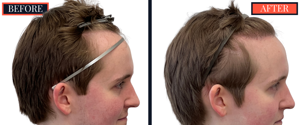 THTS Partial Shave - 753 GRAFT FUE - Results