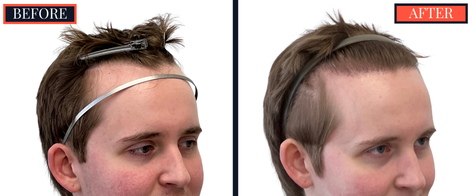 THTS Partial Shave - 753 GRAFT FUE - Results