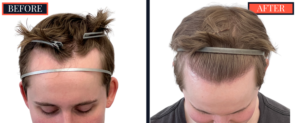 THTS Partial Shave - 753 GRAFT FUE - Results