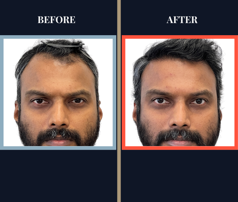 Post-1279 graft FUE hair transplant surgery result photo - feature image patient facing forward