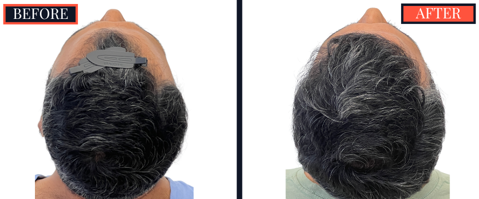 Post-1279 graft FUE hair transplant surgery result photo - patient facing back - head tipped up
