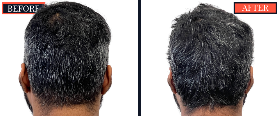 Post-1279 graft FUE hair transplant surgery result photo - patient facing back