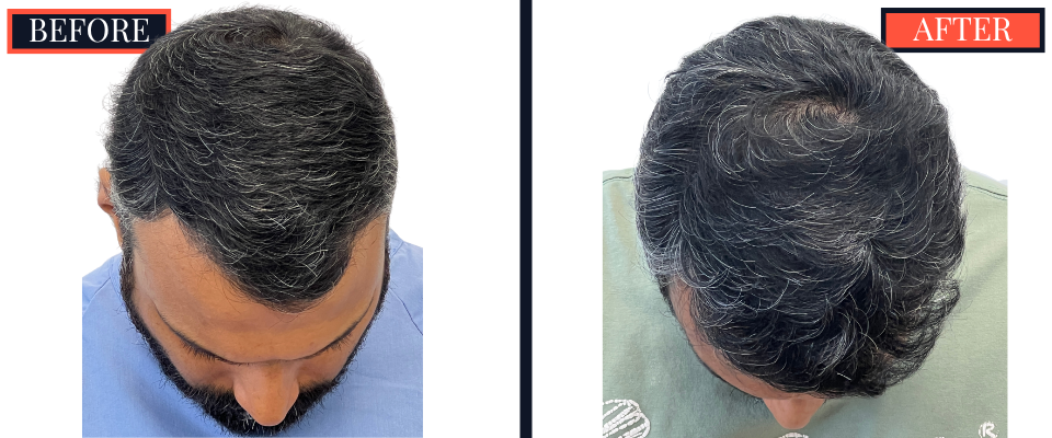 Post-1279 graft FUE hair transplant surgery result photo - patient facing front with head tipped down