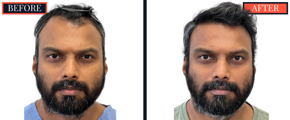 Post-1279 graft FUE hair transplant surgery result photo - patient facing front