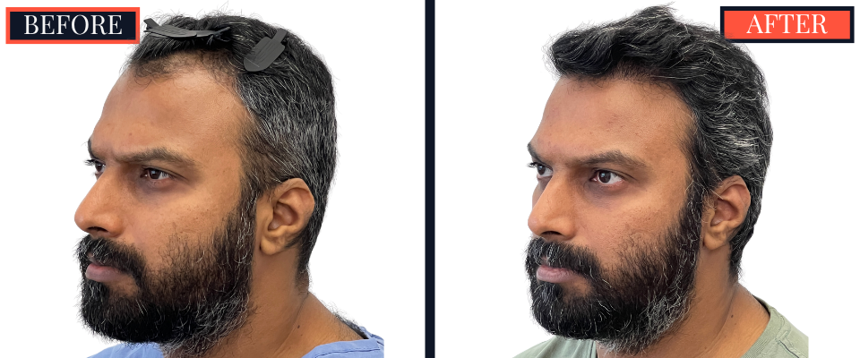 Post-1279 graft FUE hair transplant surgery result photo - patient facing left offset