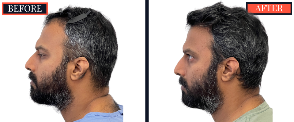Post-1279 graft FUE hair transplant surgery result photo - patient facing left
