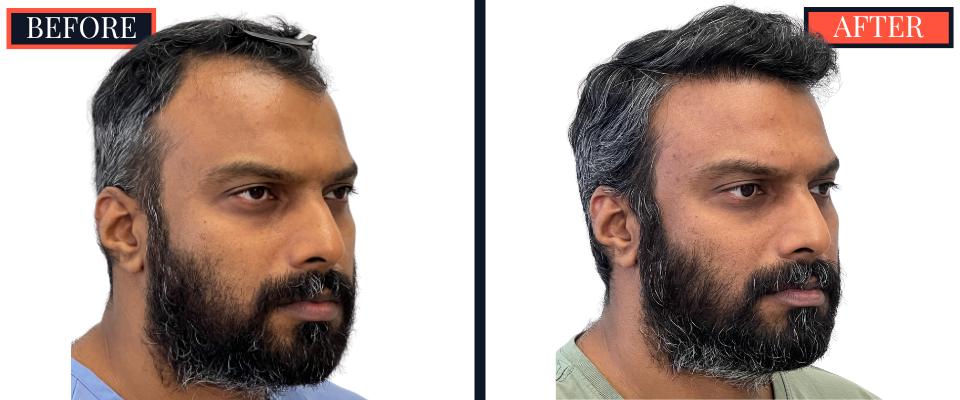 Post-1279 graft FUE hair transplant surgery result photo - patient facing right offset