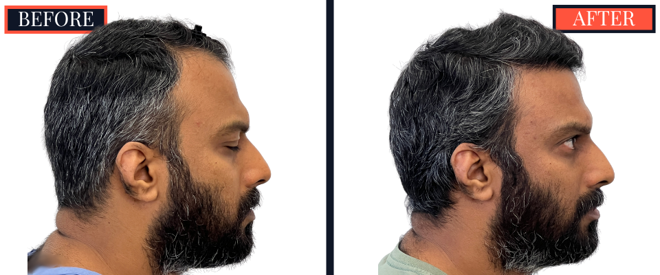 Post-1279 graft FUE hair transplant surgery result photo - patient facing right