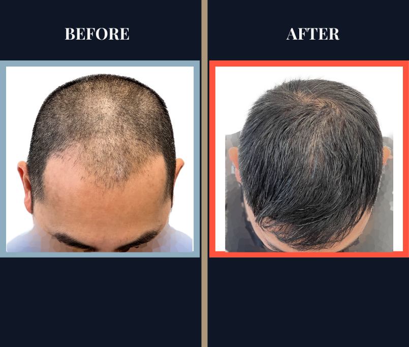 2425 graft FUE Hair Transplant - THTS - FEATURE IMAGE PHOTO