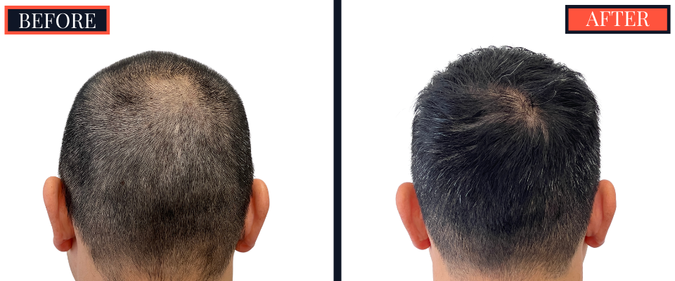 2425 graft FUE Hair Transplant - THTS - Post-Op Results Photo