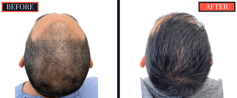 2425 graft FUE Hair Transplant - THTS - Post-Op Results Photo