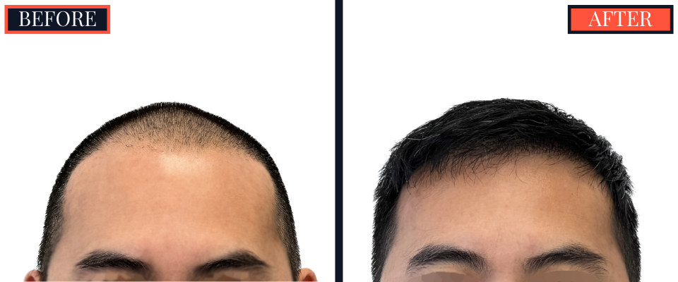 2425 graft FUE Hair Transplant - THTS - Post-Op Results Photo