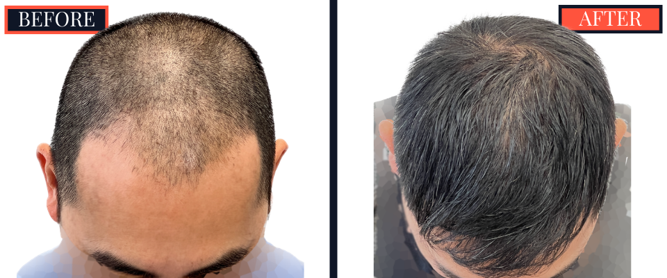 2425 graft FUE Hair Transplant - THTS - Post-Op Results Photo