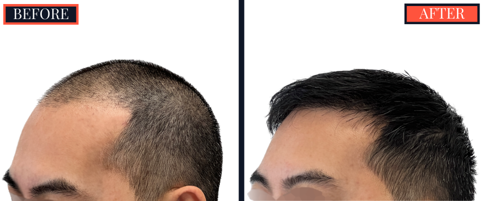 2425 graft FUE Hair Transplant - THTS - Post-Op Results Photo