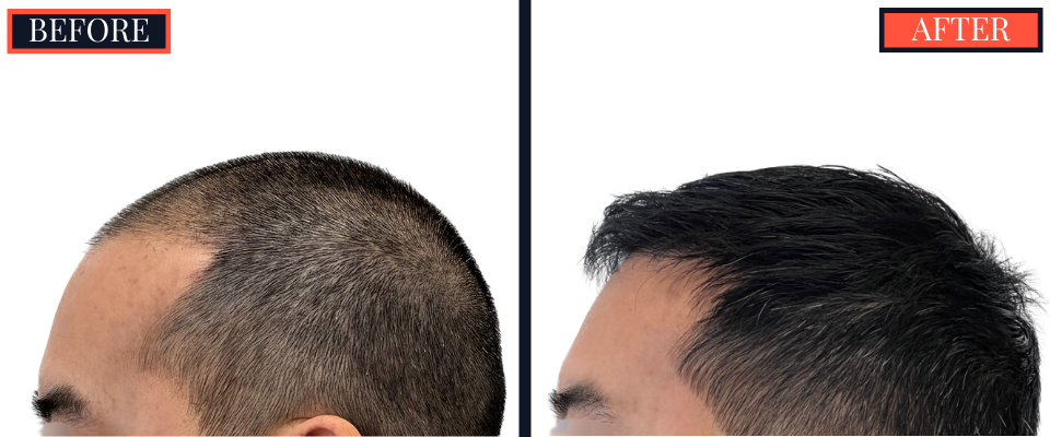 2425 graft FUE Hair Transplant - THTS - Post-Op Results Photo