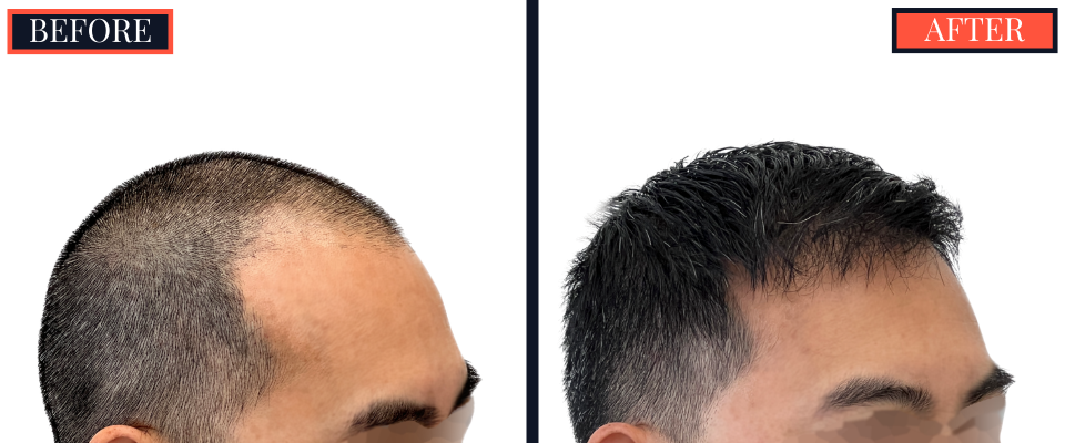 2425 graft FUE Hair Transplant - THTS - Post-Op Results Photo