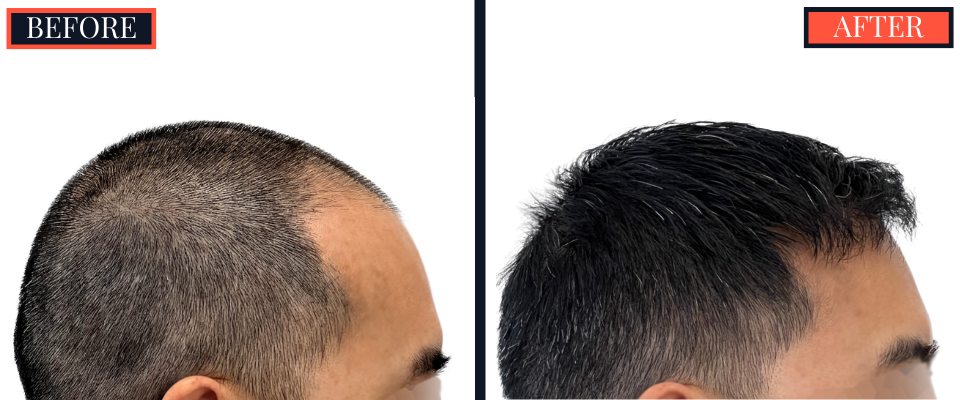 2425 graft FUE Hair Transplant - THTS - Post-Op Results Photo