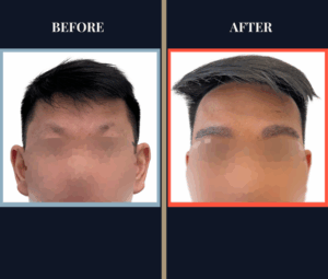 800 graft eyebrow FUE Results