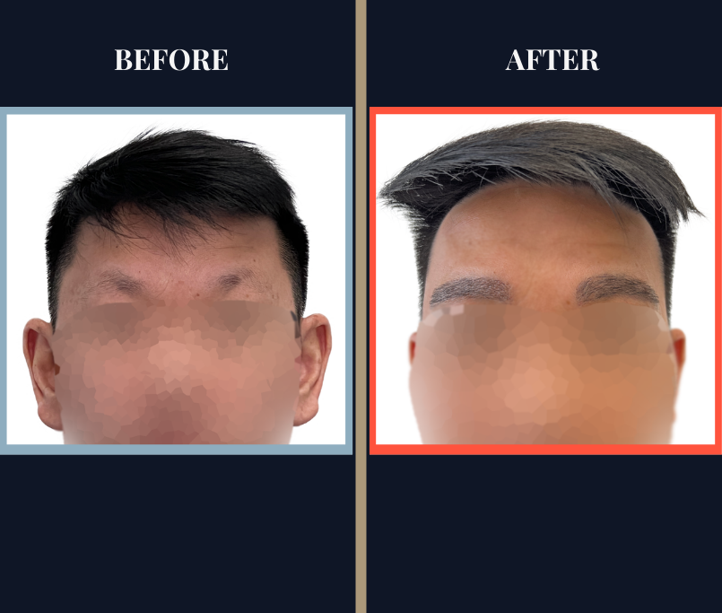 800 graft eyebrow FUE Results