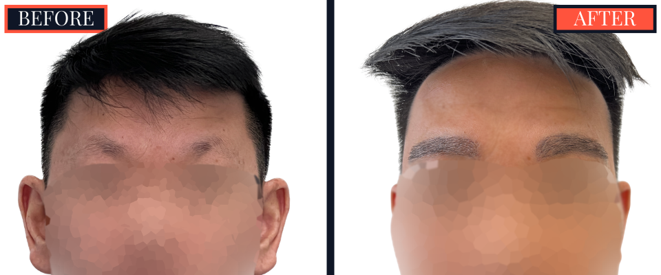 Post-Op Results - 800 graft eyebrow FUE