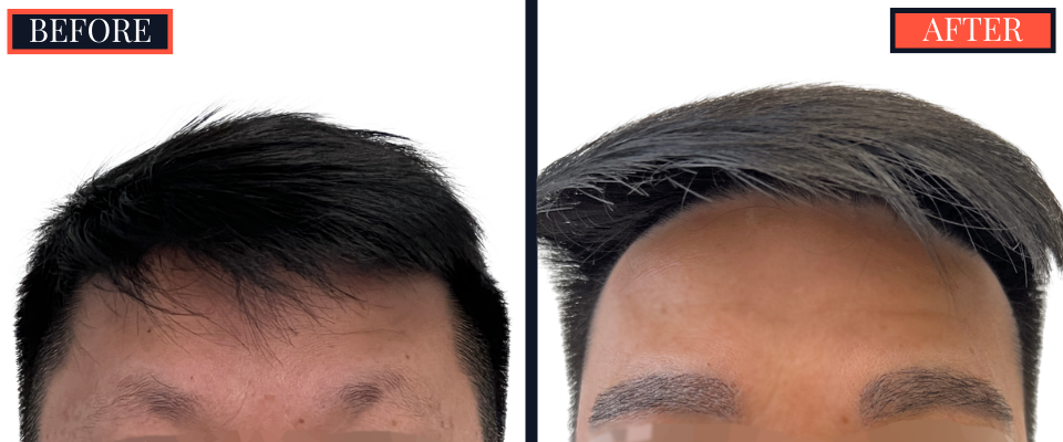 800 graft eyebrow FUE results