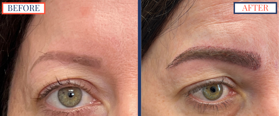 Eyebrow FUT Hair Transplant Surgery Photos