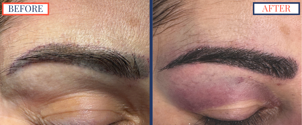 Eyebrow Hair Transplant - 650 graft FUT - Post-Op Photo left brow