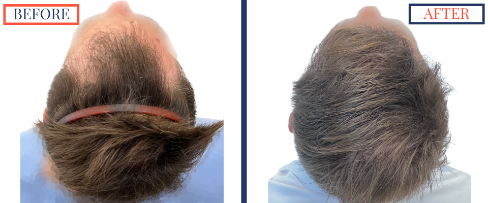 1387 Graft FUE hair transplant results