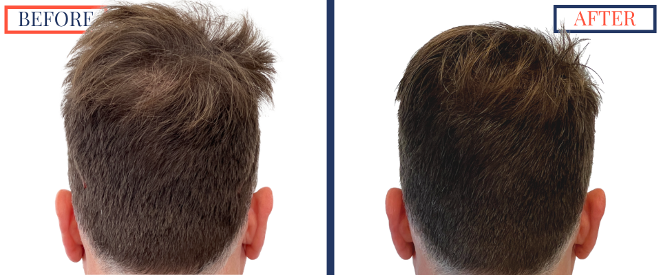 1387 Graft FUE hair transplant results