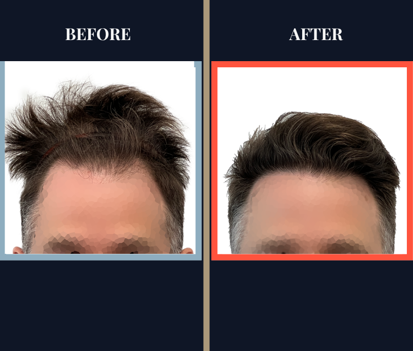 1387 Graft FUE hair transplant results