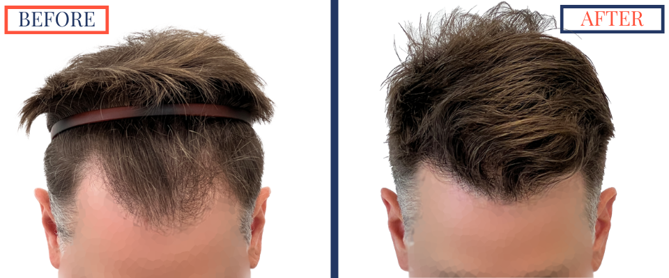 1387 Graft FUE hair transplant results
