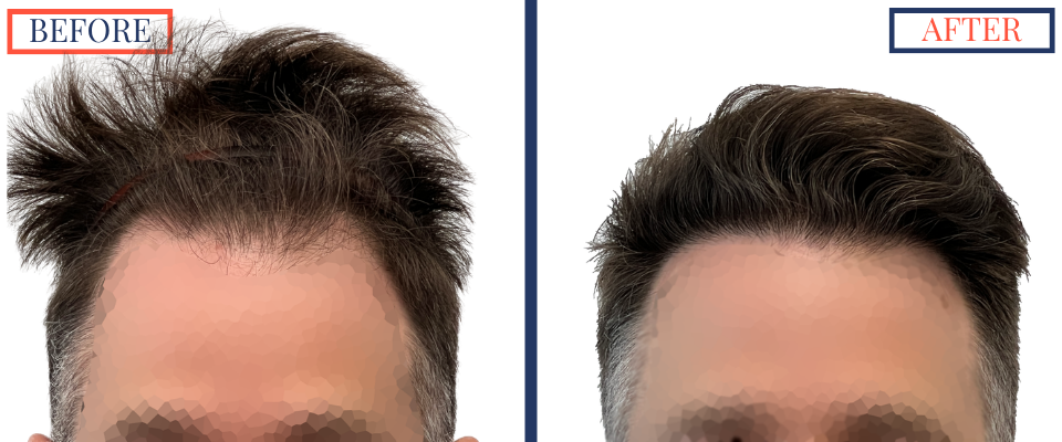 1387 Graft FUE hair transplant results
