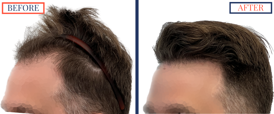 1387 Graft FUE hair transplant results