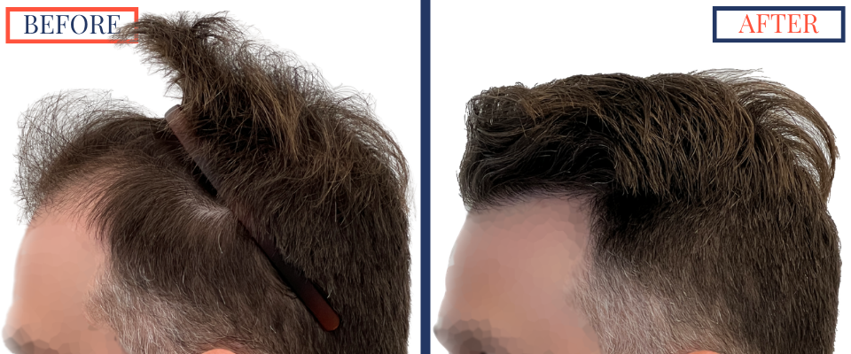 1387 Graft FUE hair transplant results
