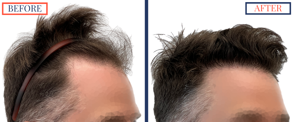 1387 Graft FUE hair transplant results