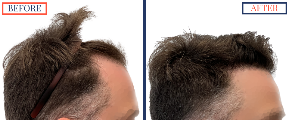 1387 Graft FUE hair transplant results