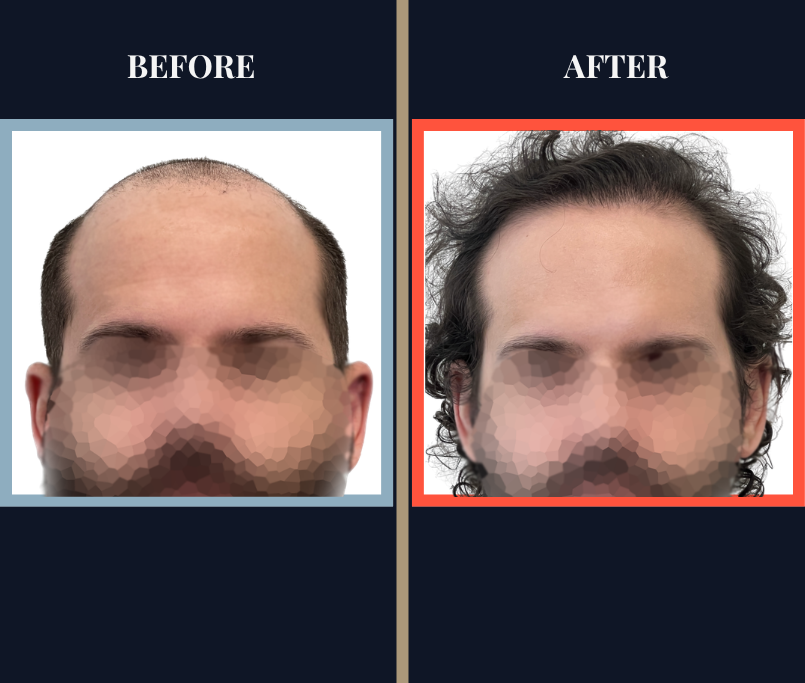 2623 graft FUE hair transplant results