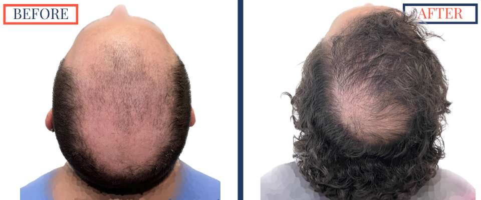 2623 graft FUE hair transplant results