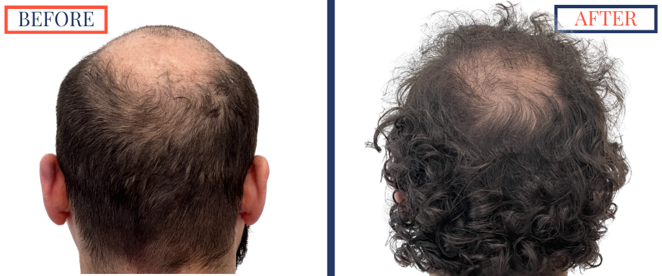 2623 graft FUE hair transplant results
