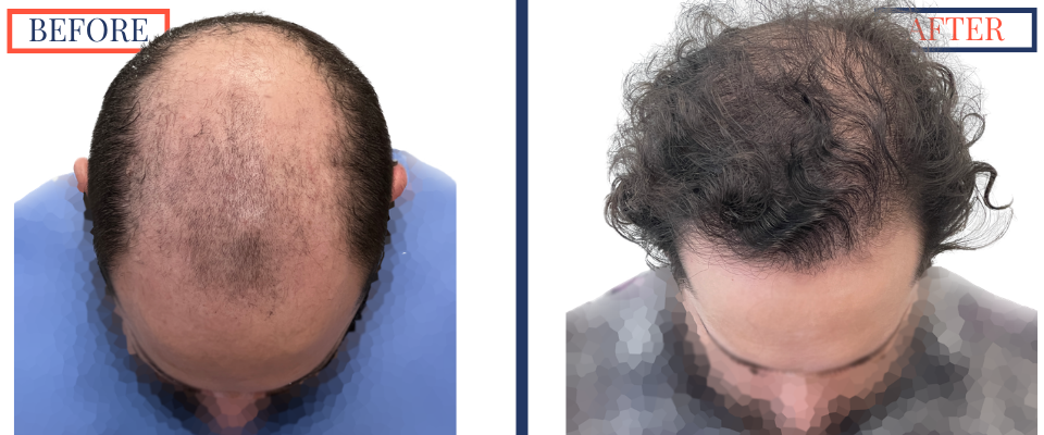 2623 graft FUE hair transplant results