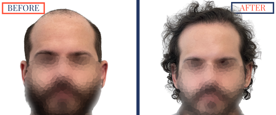 2623 graft FUE hair transplant results